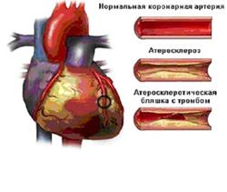 Коронарная артерия