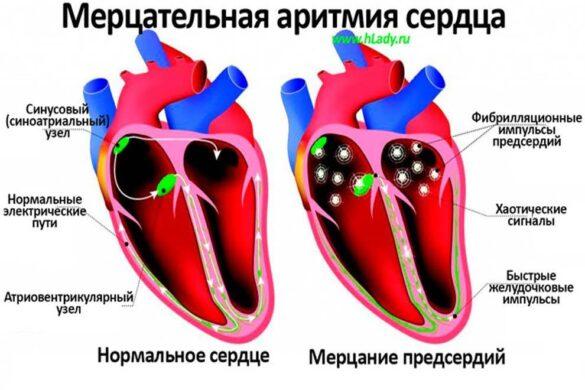 Симптомы и лечение мерцательной аритмии сердца - Всё о сердце