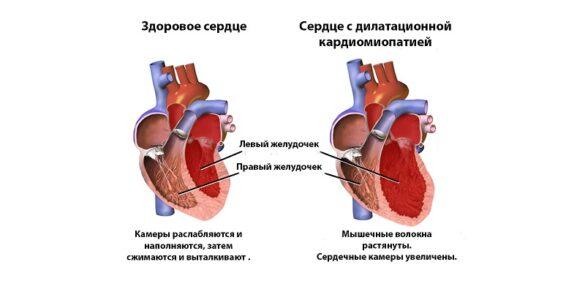 Гипертрофическая кардиомиопатия - Всё о сердце