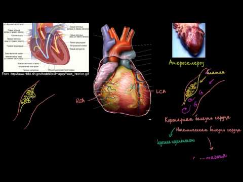 Классификация ИБС - Всё о сердце