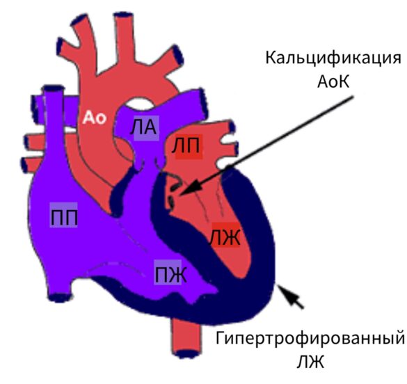 Аортальный стеноз - Всё о сердце