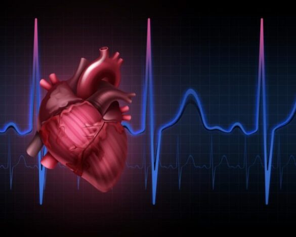 Аритмия сердца - Всё о сердце