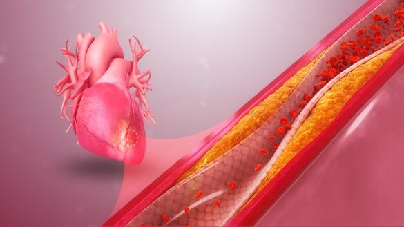 Атеросклеротический кардиосклероз: код по МКБ-10, причины, лечение - Всё о сердце