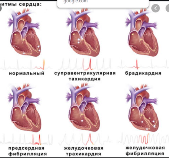 Чем опасна аритмия сердца - Всё о сердце