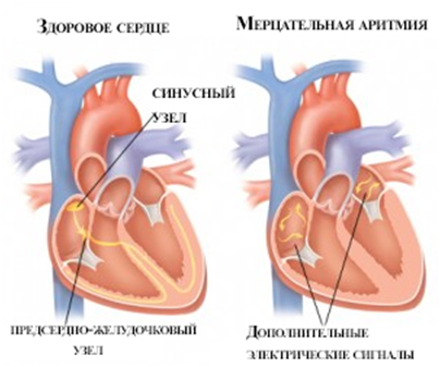 Лечение мерцательной аритмии - Всё о сердце
