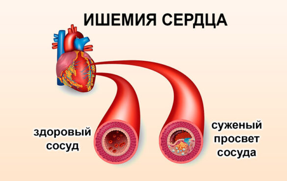 Заболевания сердца - Всё о сердце