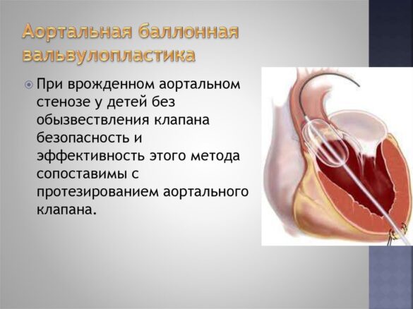 Стеноз аорты у новорожденных - Всё о сердце